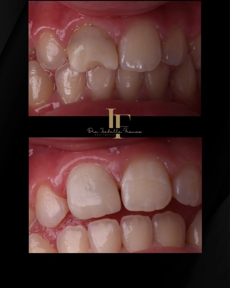 Comparativo clínico de dente antes e depois de restauração estética